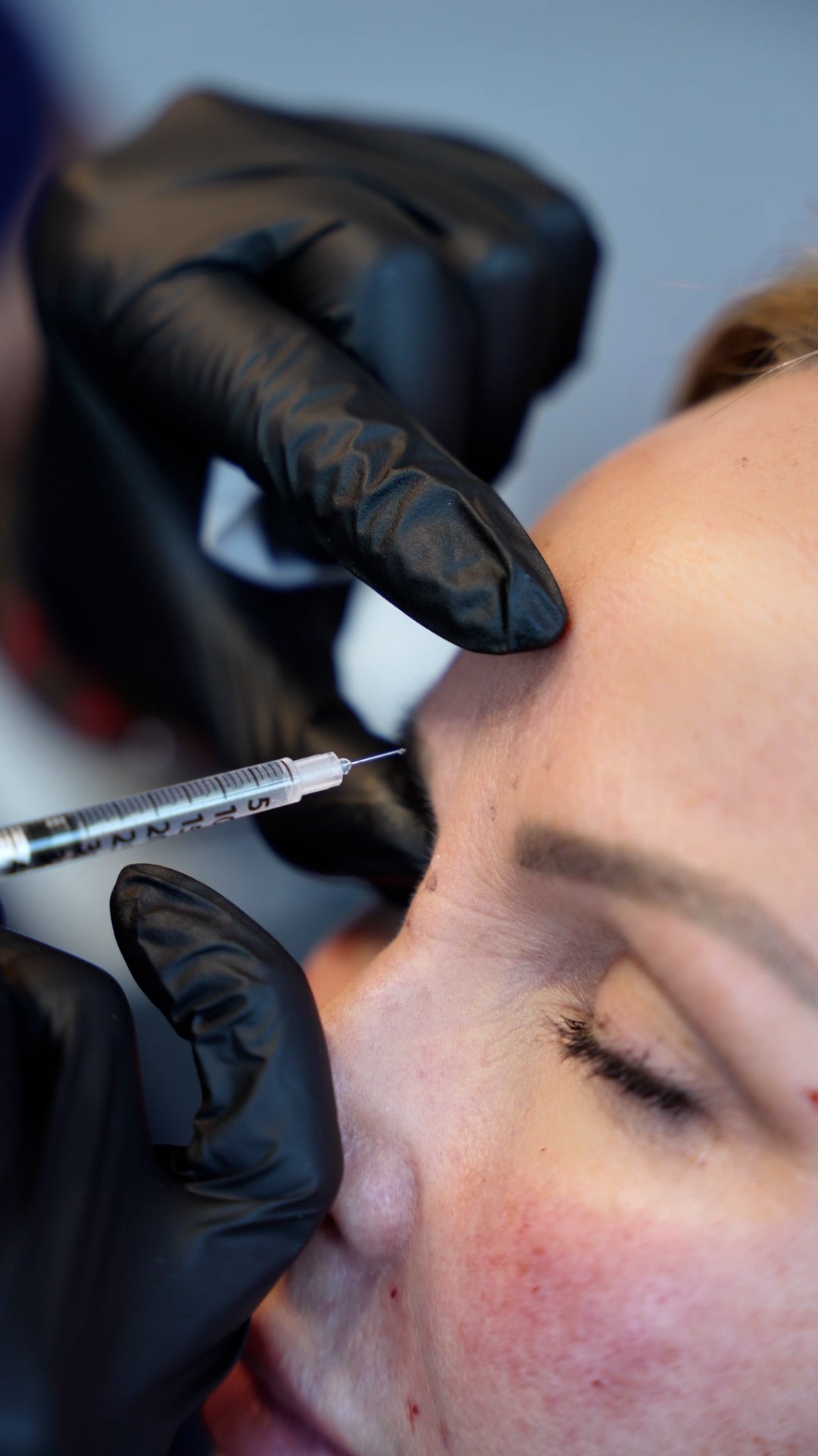 Tox Anti- Wrinkle 60 units