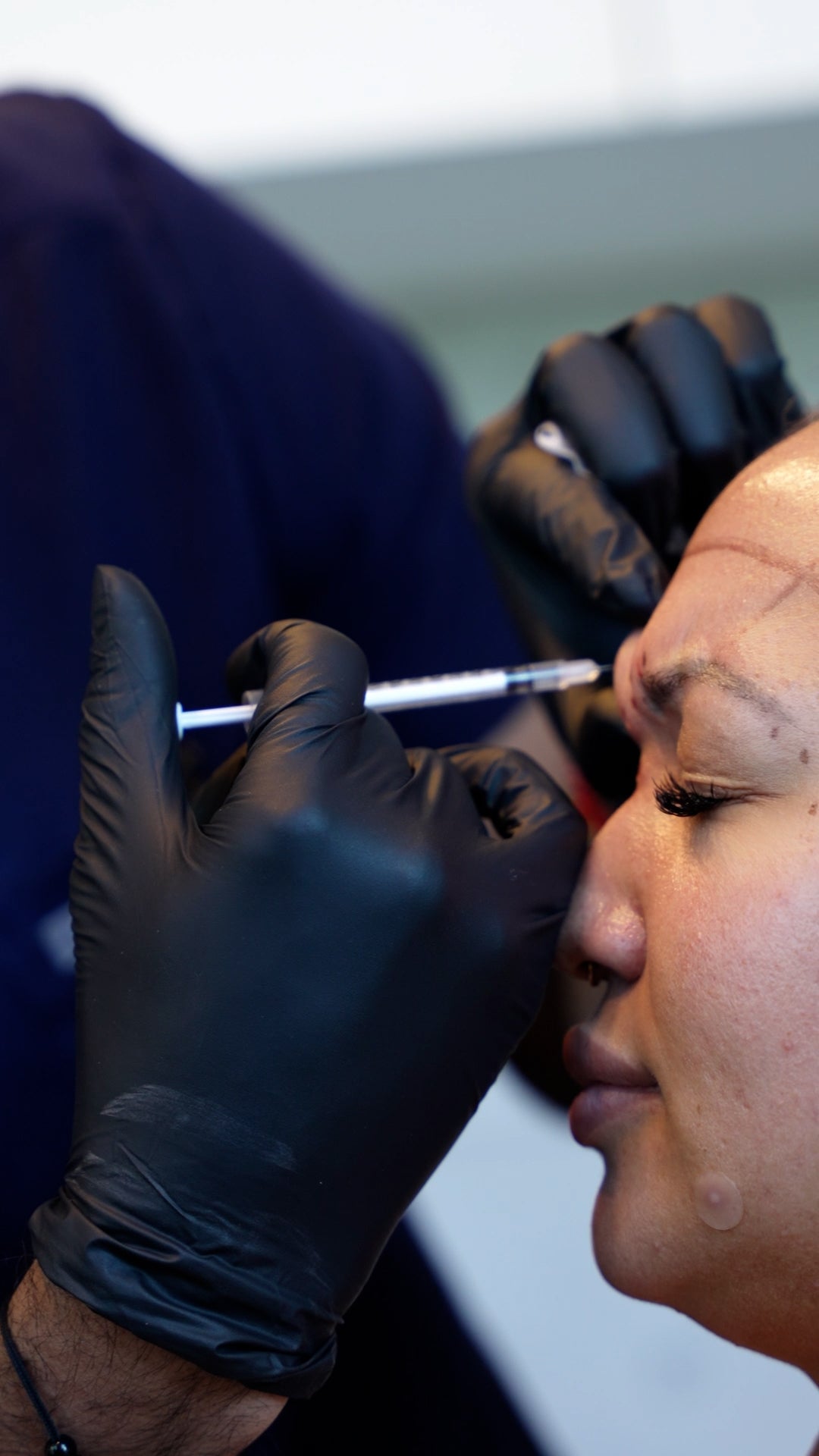 Tox Anti- Wrinkle 60 units