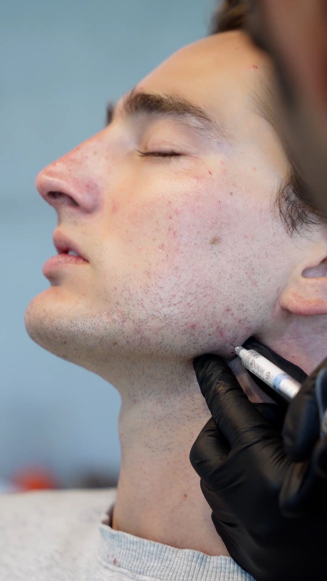 Mens Jawline Contouring