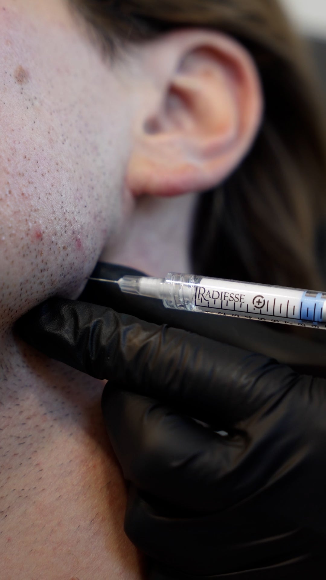 Mens Jawline Contouring