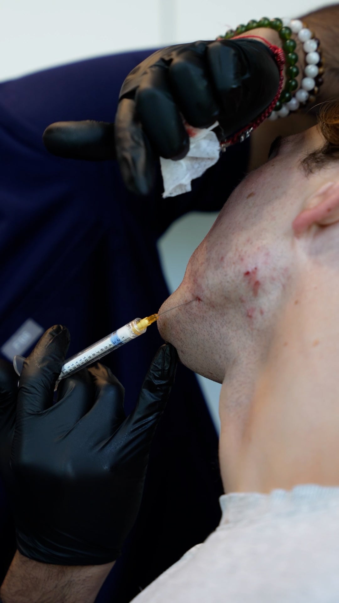 Mens Jawline Contouring