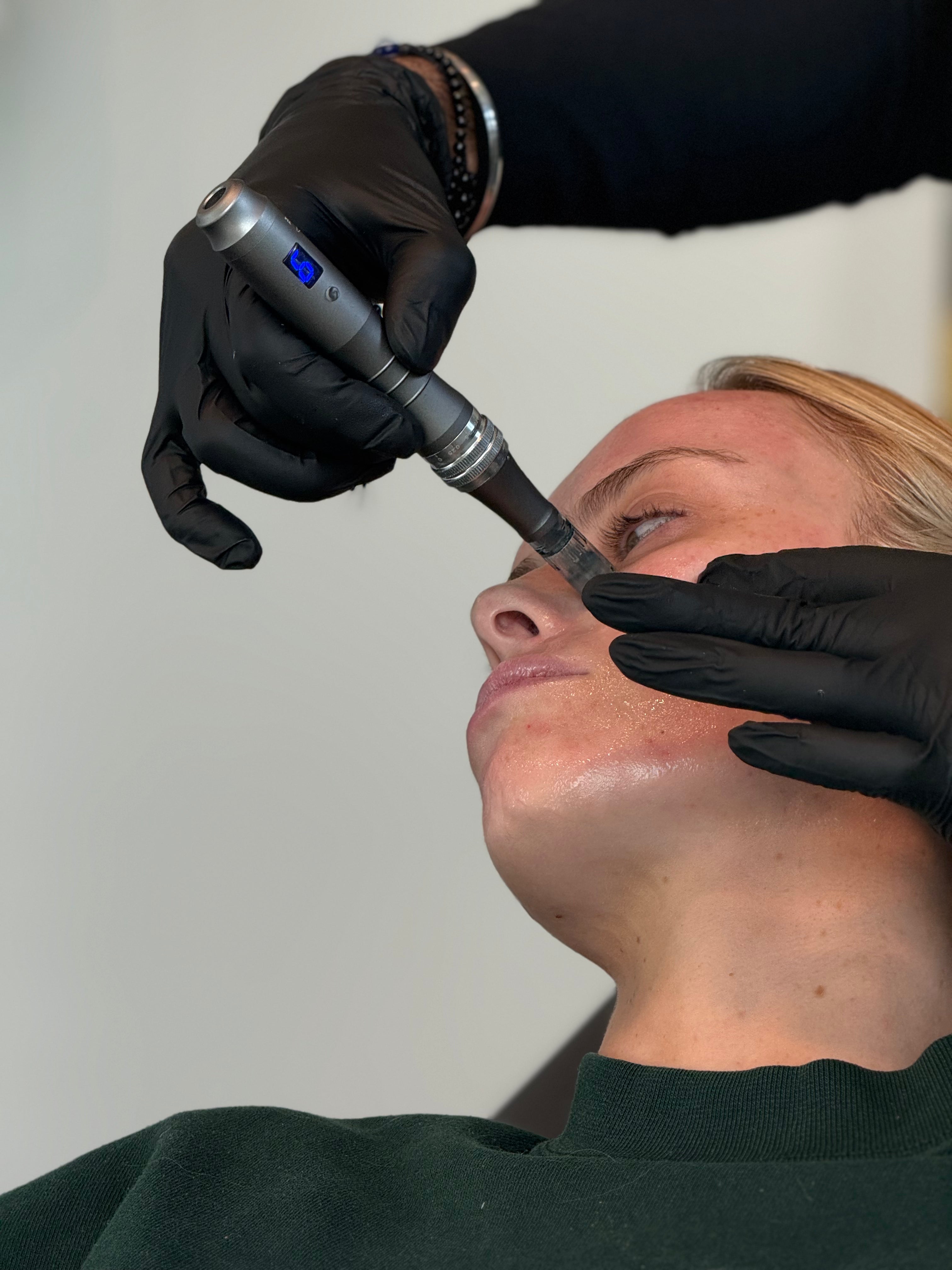 Micro-needling With Salmon DNA