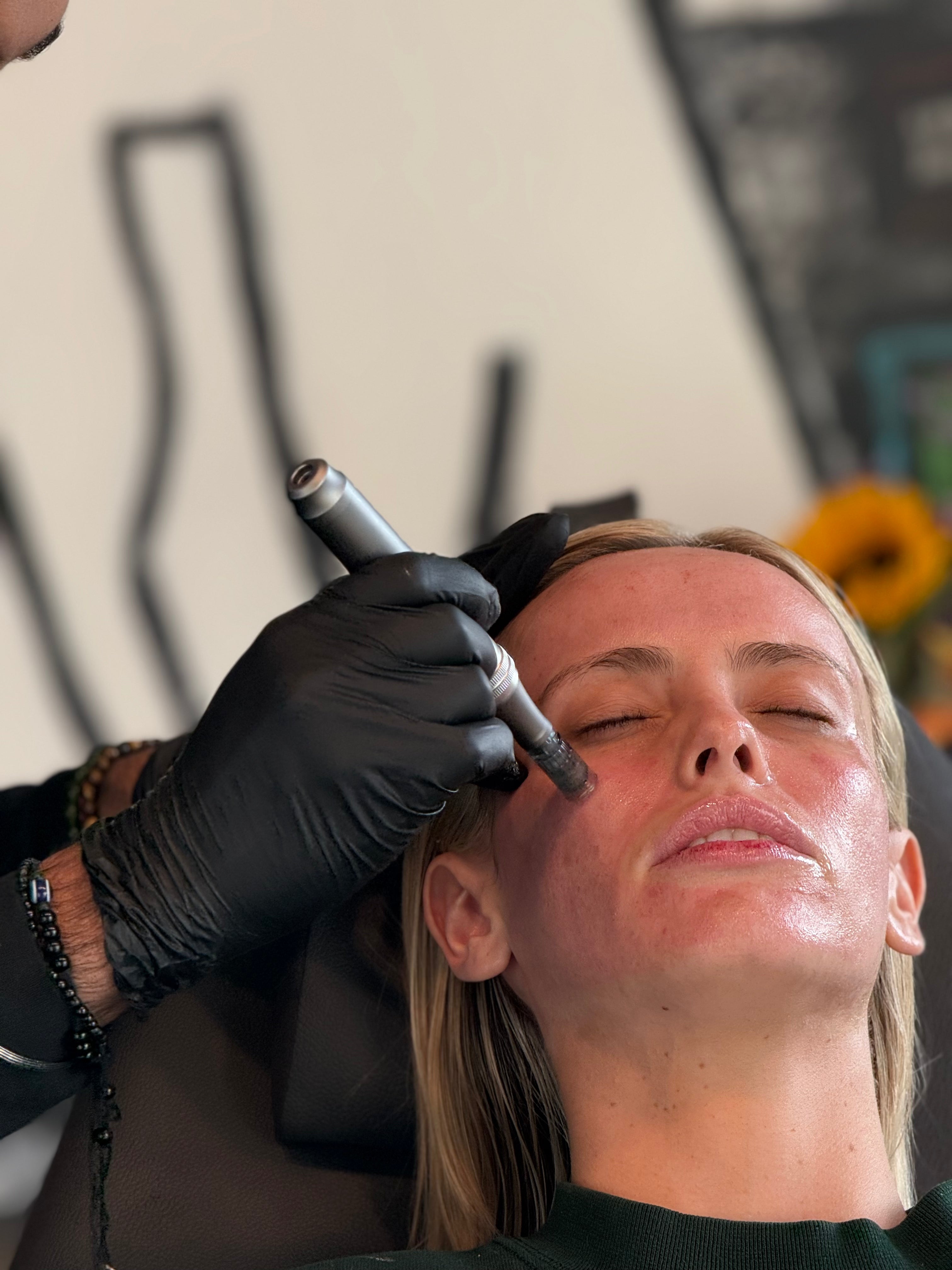 Micro-needling With Salmon DNA